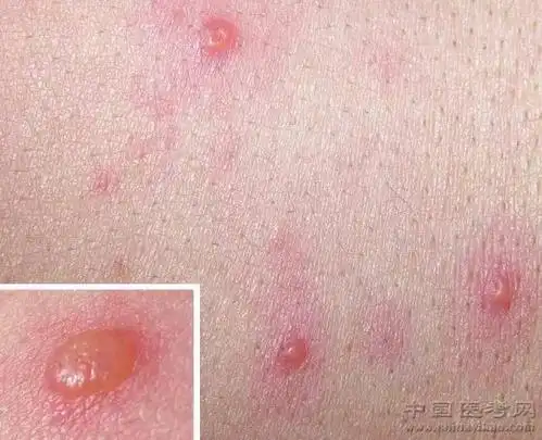 史上最全常见皮肤病图谱