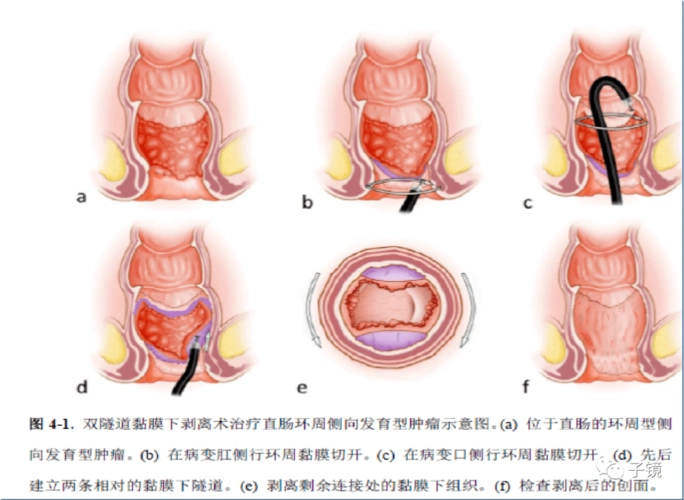 5,困难大肠esd原因:大面积病变,侵犯肛门齿状线,右半结肠以及横结肠