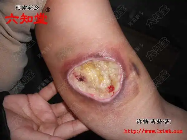 造成组织坏死治疗病例 - 韩氏膏药治疗褥疮 糖尿病足病 伤口不愈合