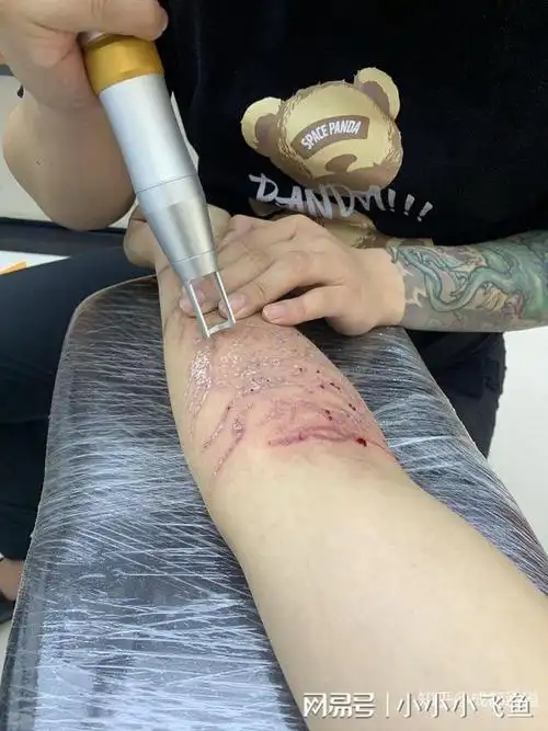 皮秒点阵激光洗纹身的真实感受