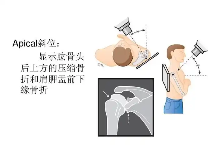 肩关节前脱位的诊断与治疗ppt