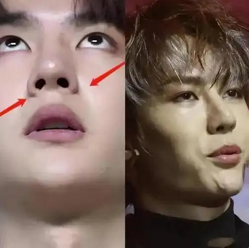 的鼻子整容的痕迹非常显眼,如果从下方观察,就会看到明显的两道疤痕