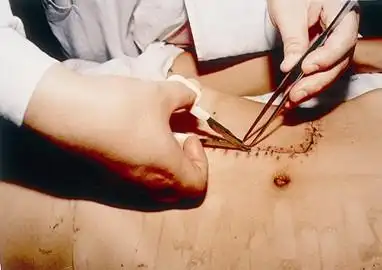 皮肤吻合器使用方法