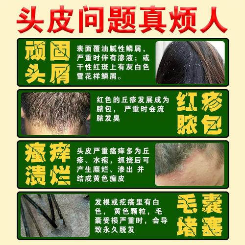 新品洗发水脂溢性皮炎头皮癣头部牛皮癣治银屑病止痒软膏头皮外用