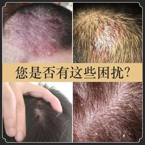 治i疗头皮毛囊炎神器全身背手臂痘痘膏去鸡皮肤疙瘩毛囊堵塞角质薬单