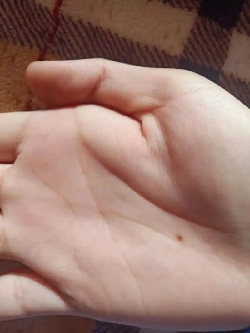 长在右手手心的痣怎么样呢