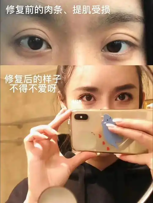 双眼皮修复前后对比
