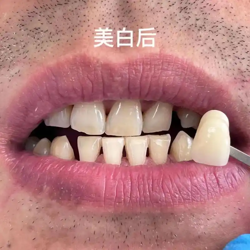 美牙前后一次对比.97|3336343730 精致girls - 抖音