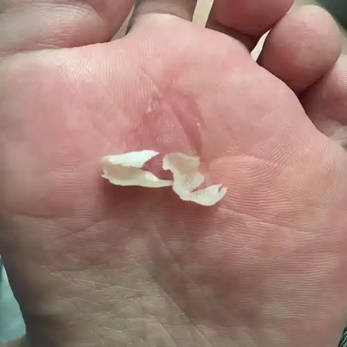 求助|脚底板长了一块像老茧一样的东西07