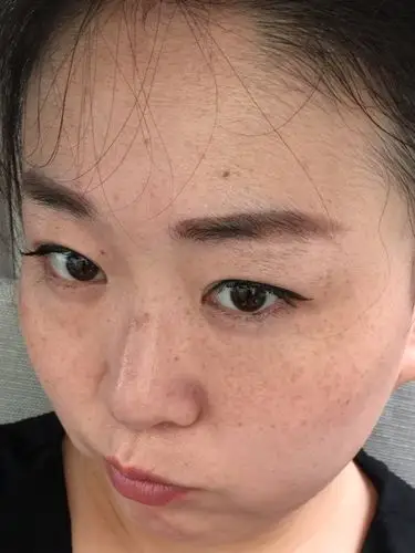 正因不注重保养,在六年前生完孩子后皮肤就一直处于又干有斑的状态