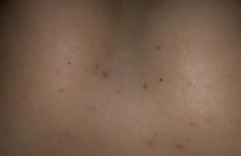 胸前突然长痘痘了咋回事,好二三个月了?