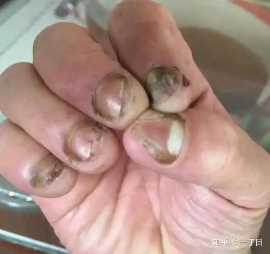 灰指甲真的那么可怕吗