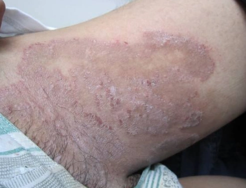 体股癣初期现象图片 (40)