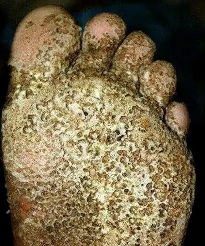 超恶心的密集恐惧症图片大全密集测试图欢迎挑战慎入2