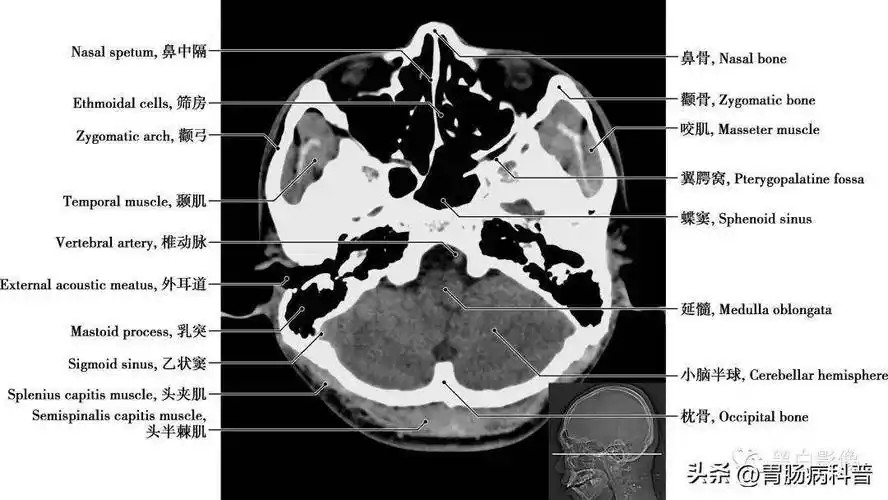 详细标注版——颅脑ct正常解剖图谱_中央_小脑_纤维
