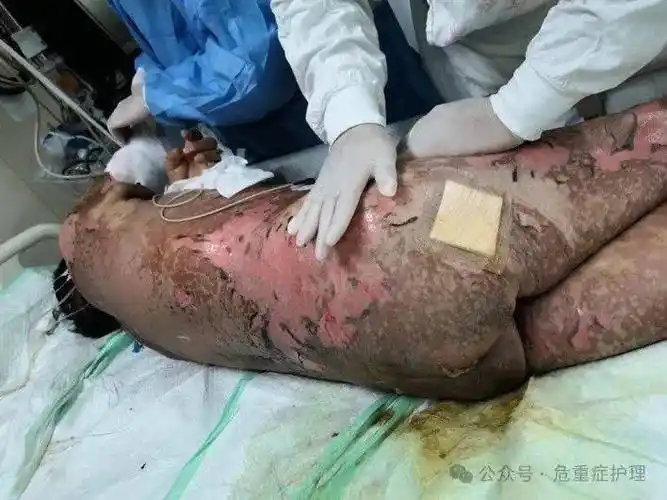 一例中毒性表皮坏死松解症患者护理分享_治疗_药物_皮肤