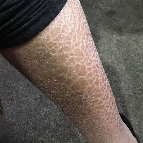 蛇皮肤鱼鳞皮肤手臂小腿胳膊干燥起皮毛周角化修复霜脱皮去鱼鳞治