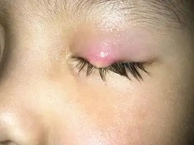 霰粒肿眼皮上长个一个红色的疙瘩图