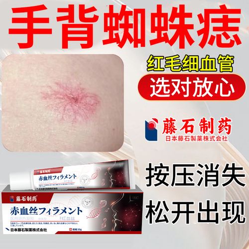 手背蜘蛛痣溶解去血管瘤血管痣身上小红痣海绵状草莓状血管瘤ui