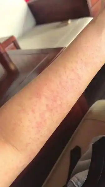 住酒店后四肢长满红疹医生诊断为屋尘螨过敏酒店不认可