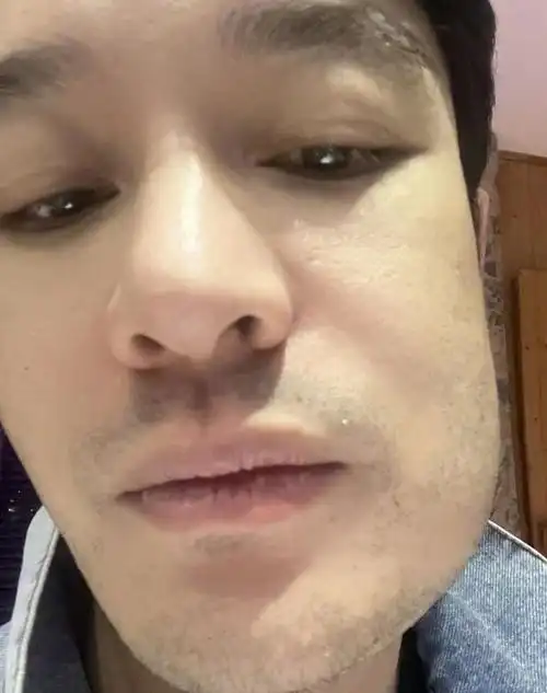 6月8日,知名男演员黄晓明通过微博晒出了两张自拍照,因为智齿发炎导致