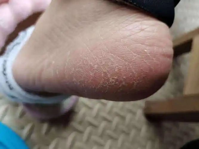 3,如果脚上皮肤细胞的新陈代谢速度比较慢,这样也容易出现脚开裂的