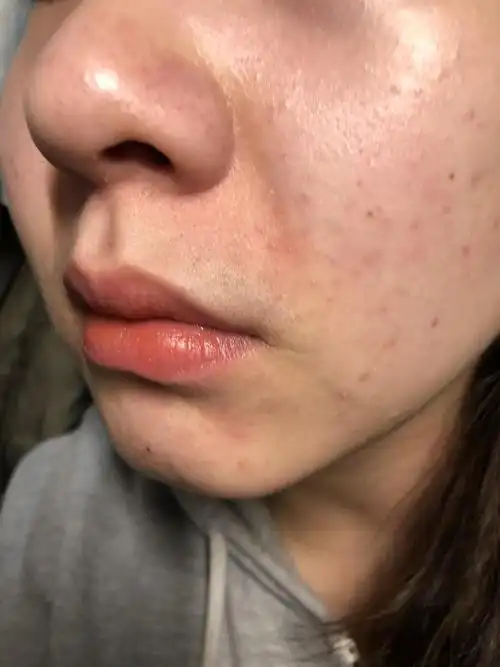 脂溢性皮炎还有救吗?(内有图慎入)