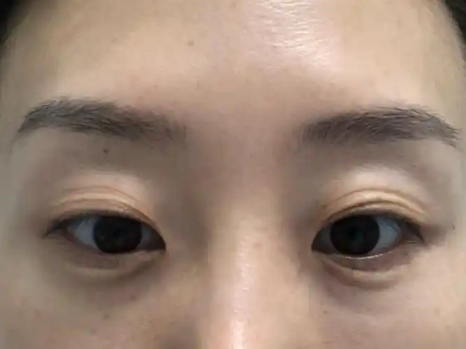 [:163]体验前变美诉求:多层眼皮,皮肤薄,褶皱_圈子-新氧美容整形