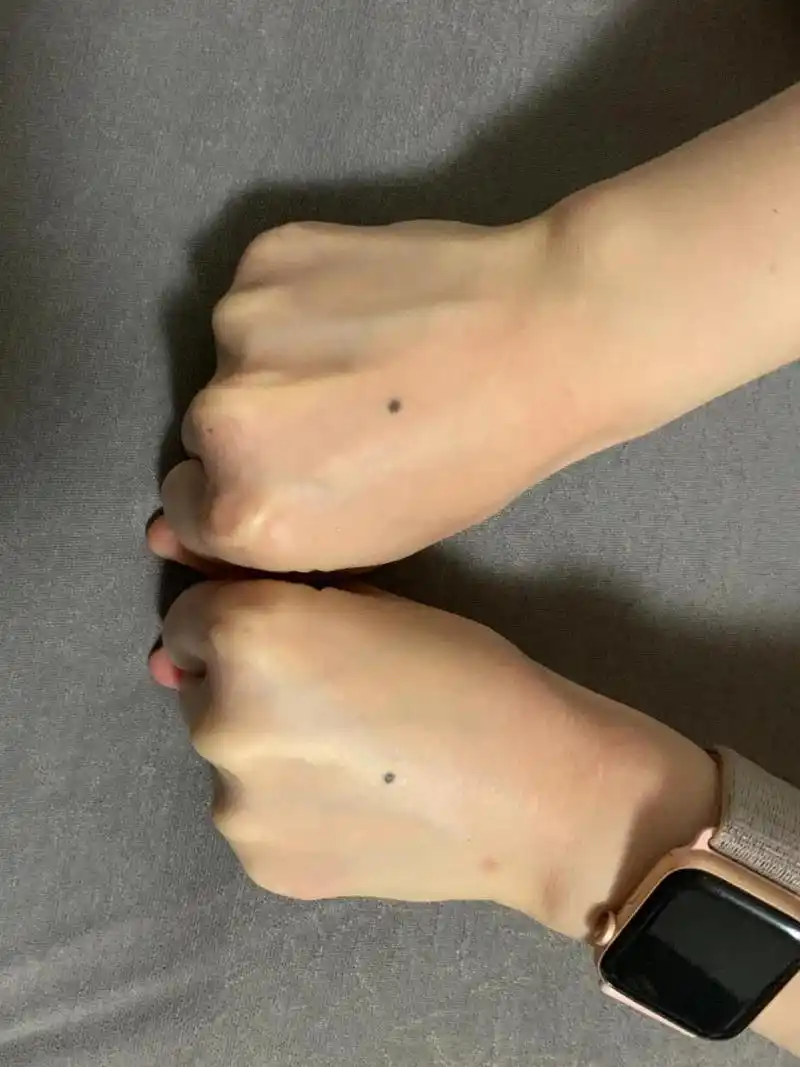 关于手背长痣/ 愿一生幸运 自我记事起,左右两只手背就有两颗对称的