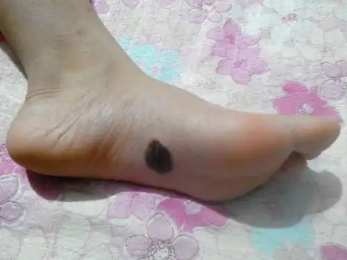 我是女孩,请问脚底长痣,出生像芝麻那么小,我长大它也大了,脚底长痣有