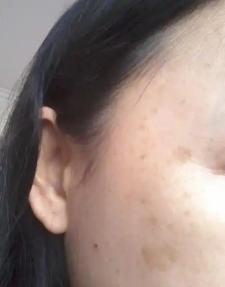 干性皮肤,突然发现脸颊长了2块指甲盖大的斑,颜色呈褐色,因为皮肤较白