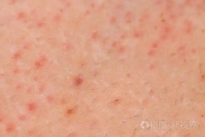 女性皮肤毛囊炎