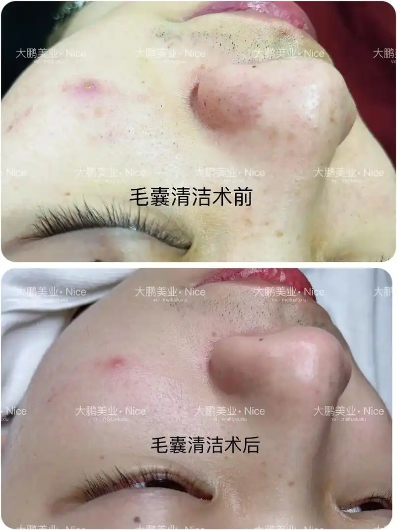 毛囊清洁术清洁界c位出道