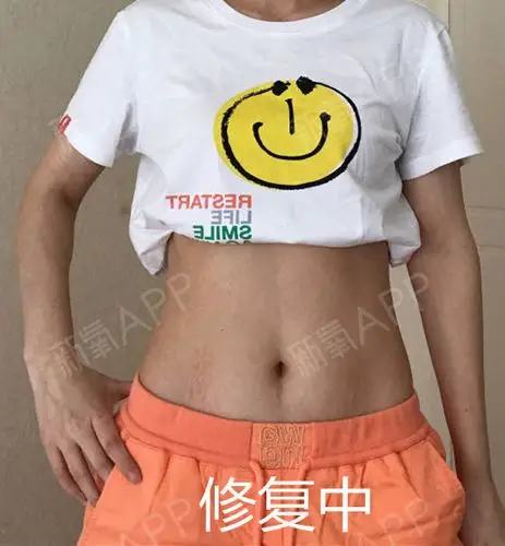 郭女士产后肚脐两侧留下了比较明显的妊娠纹,呈褐色,偶有发痒