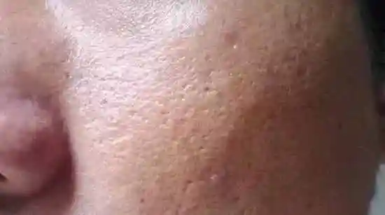 毛孔粗大有很多原因,但是归结起来无非是皮肤老化了或者是毛孔堵塞了