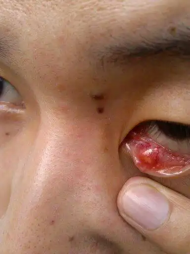 眼底眼皮内下长了泡,黄豆粒大小,上面有