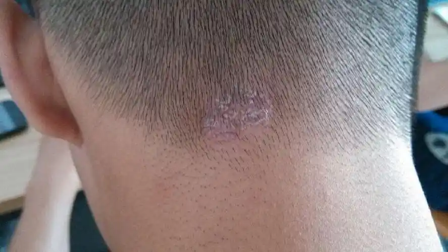 问:头皮起了个包,症状 脱皮 微痒,求解