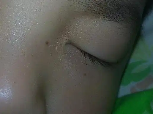 有没有小孩脸上长痣的?不是1个,是好几个!