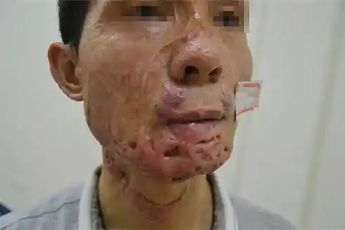 河北省中医院胎记疤痕·今天 16:22皮肤粗糙有鸡皮疙瘩,竟然跟鱼鳞病