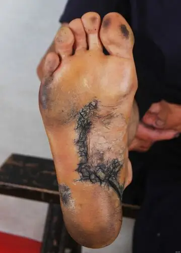 【病例讨论】严重开裂的皮肤病 [病例帖]