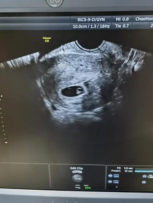 终于接到了属于我的热乎乎的胎芽胎心