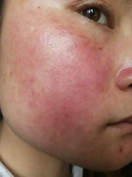 脸上皮肤过敏怎么办? 几种皮肤过敏的治疗方法