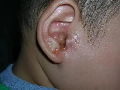 九江市妇幼保健院耳鼻喉科雷盛钦主任介绍,耳道,耳廓,耳后都可能出现
