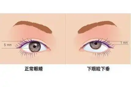 眼睑下垂和肌无力的区别