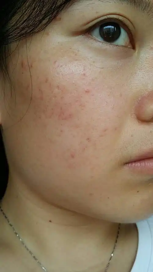 体内油脂分泌旺盛导致大油田擦什么都嫌油了夏天一层层的油冬天稍好