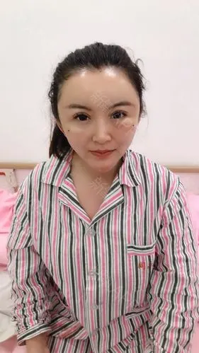 自体脂肪填充全脸