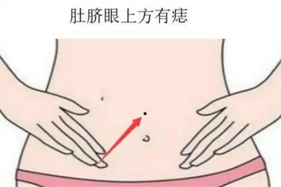 肚脐眼旁边的痣预示着什么