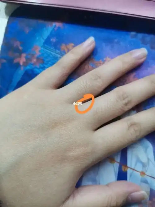 大概一年前突然发现指缝靠近左手中指的地方长了颗痣(图二更清楚)想