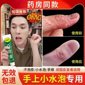 手癣手足藓脱皮水泡汗孢疹真菌感染止痒汗疱疹手痒专用鹅掌风药膏