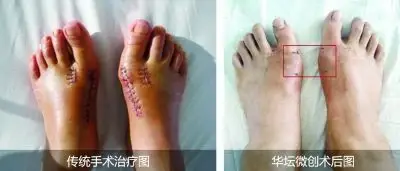 (脚觚拐)不缝针,无需钢钉内固定,恢复快,不留后遗症|手术_新浪新闻